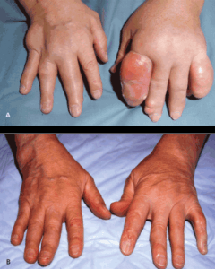 Tophaceous Hands Photographs