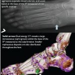 Bone Erosion from Gouty Tophi